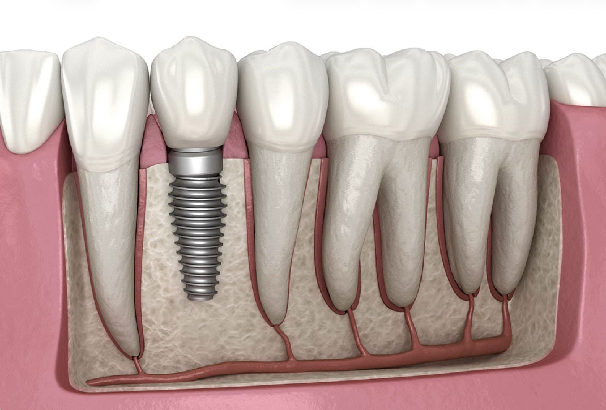 Implant Information Guide